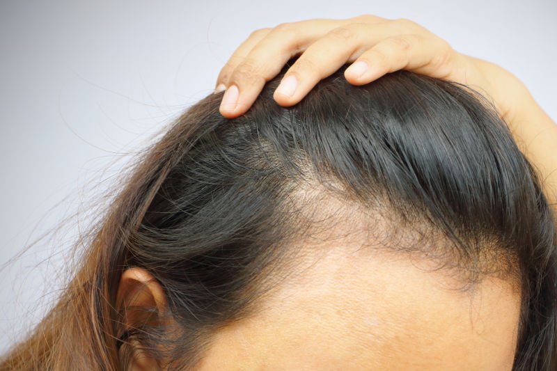 Female Hair Loss Treatment Amersham