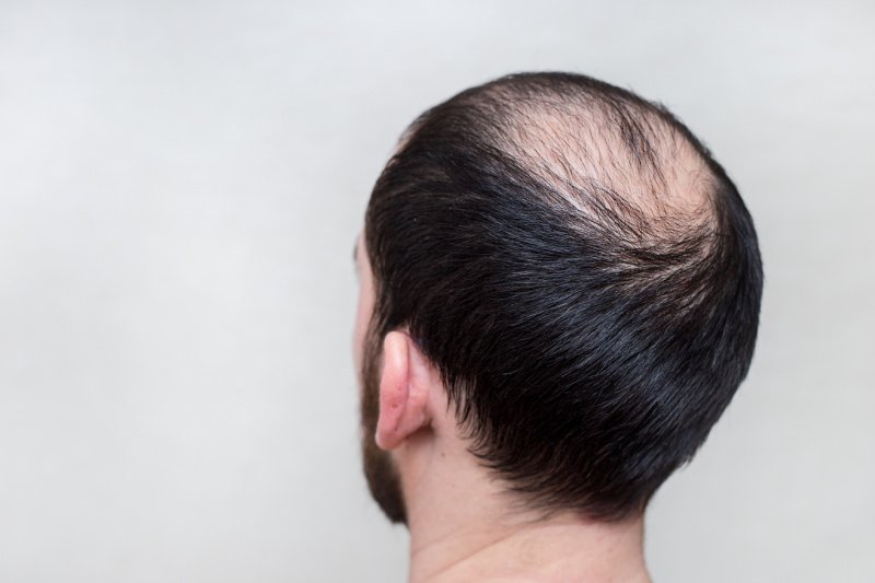 Balding Treatment Mesotherapy at our Clinic in Hazelmere