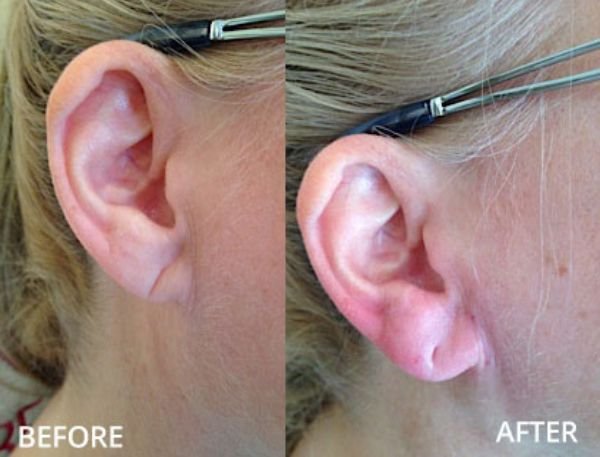 Earlobe Rejuvenation with Fillers